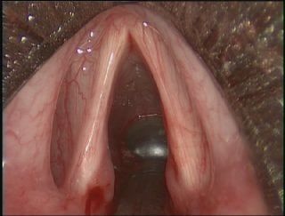 Vocal Cord Injection Laryngoplasty - Voice and Swallowing Doctor - Sunil Verma MD