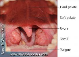Tonsils - Voice and Swallowing Doctor - Sunil Verma MD