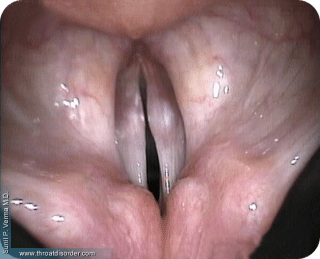 Nodules- Voice and Swallowing Doctor - Sunil Verma MD
