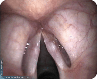 Nodules- Voice and Swallowing Doctor - Sunil Verma MD
