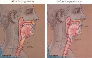 Laryngectomy and Neck Dissection - Voice and Swallowing Doctor - Sunil Verma MD