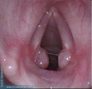 Granuloma - Voice and Swallowing Doctor - Sunil Verma MD