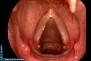Granuloma - Voice and Swallowing Doctor - Sunil Verma MD
