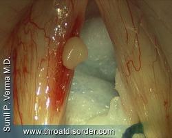 Vocal Fold Cyst-Voice and Swallowing Doctor - Sunil Verma MD
