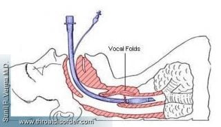 Hoarseness After Surgery-Voice and Swallowing Doctor - Sunil Verma MD