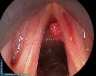 polyps-Voice and Swallowing Doctor - Sunil Verma MD