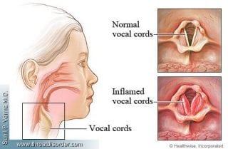 Laryngitis - Voice and Swallowing Doctor - Sunil Verma MD