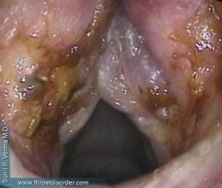 Laryngitis Sicca - Voice and Swallowing Doctor - Sunil Verma MD
