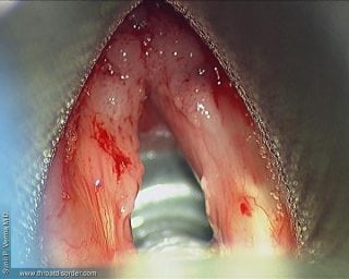 papilloma-Voice and Swallowing Doctor - Sunil Verma MD