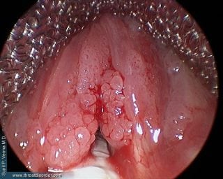 laryngeal papilloma papillomatosis