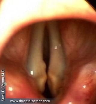 Aging Voice-Voice and Swallowing Doctor - Sunil Verma MD