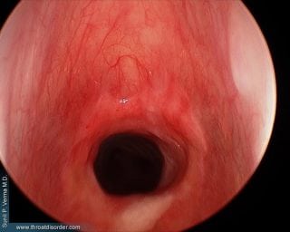 Subglottic Stenosis - Voice and Swallowing Doctor - Sunil Verma MD