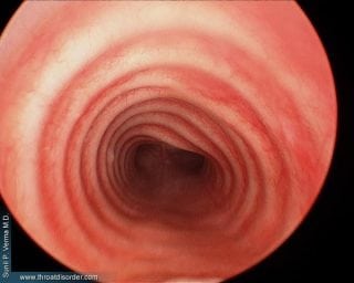 trachea-Voice and Swallowing Doctor-Sunil Verma MD