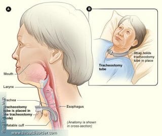 tracheostomy - Voice and Swallowing Doctor - Sunil Verma MD