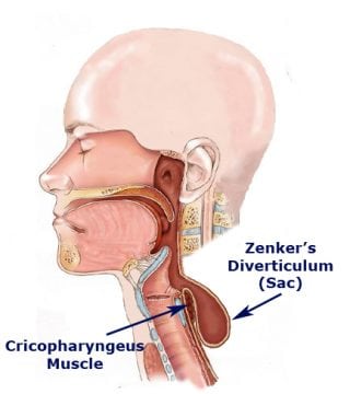 Zenker's Diverticulum-Voice and Swallowing Doctor-Sunil Verma MD